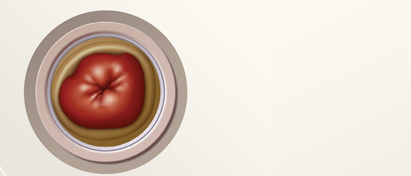 illustration of a stoma