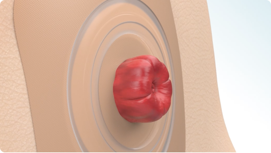 an illustration of a stoma