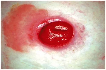 Candidiasis