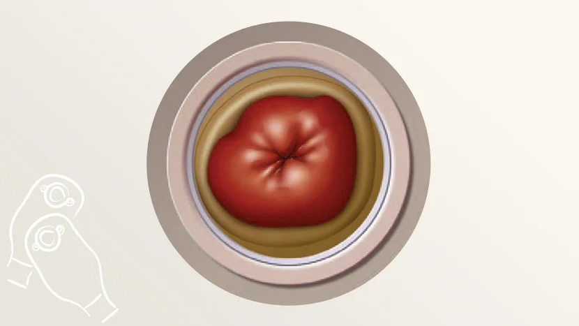 an illustration of a stoma