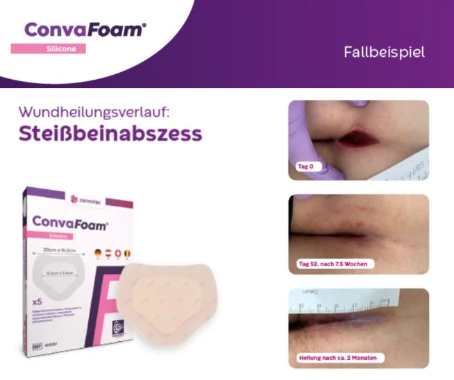 Die Abbildung zeigt den Wundheilungsverlauf des Steißbeinabzesses und den Wundverband sowie die Verpackung von ConvaFoam Silicone
