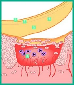 illustration of how wound dressing works
