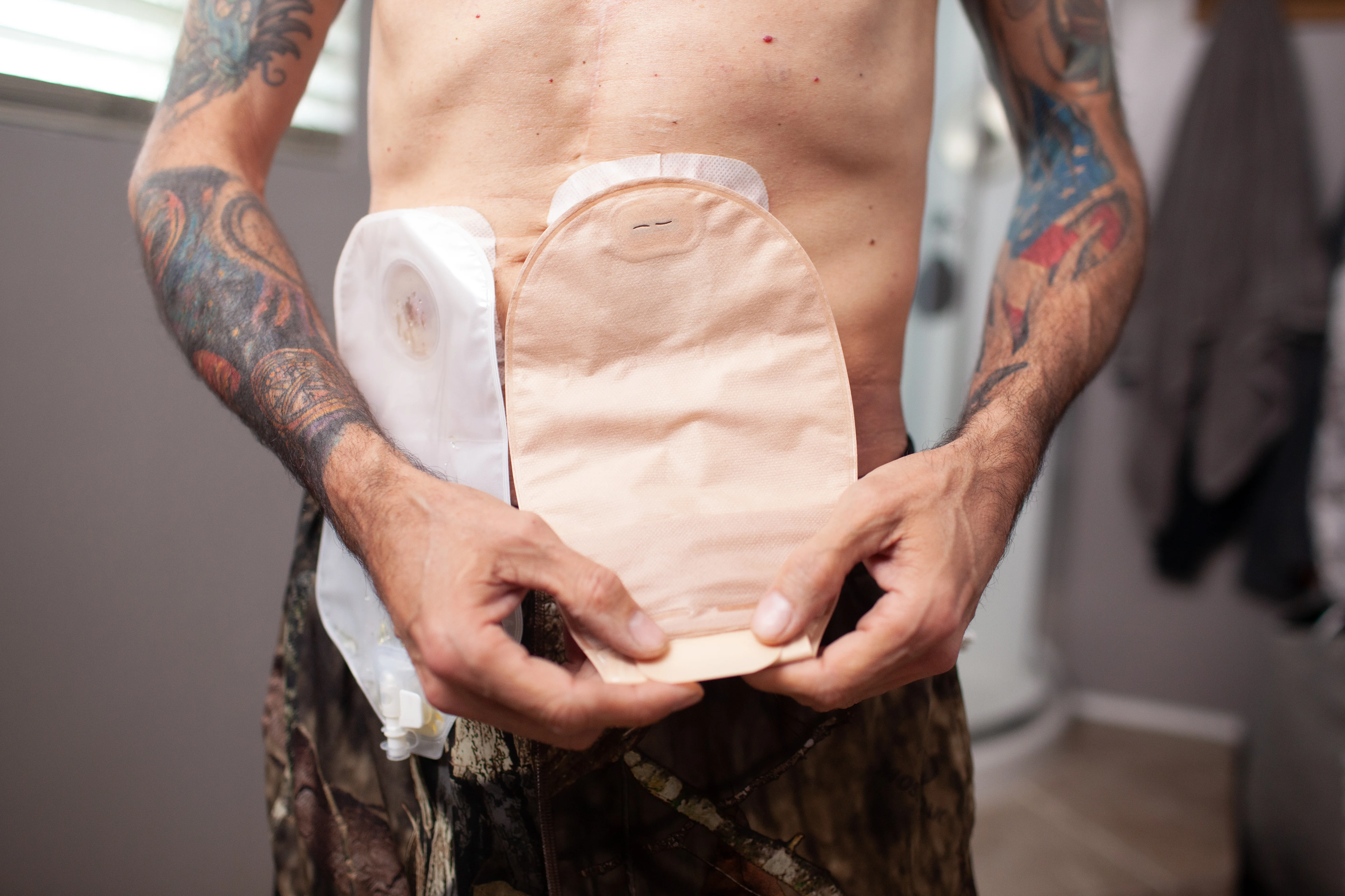 a man with stomas