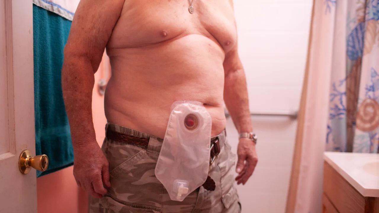Uma foto de uma pessoa usando uma bolsa de ostomia.