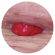 Soft or Flaccid Abdomens